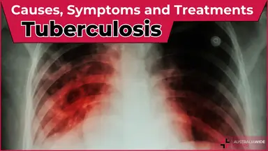Tuberculosis article header – First Aid Article in Richmond