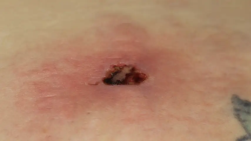 A necrotic skin wound from a brown recluse spider bite